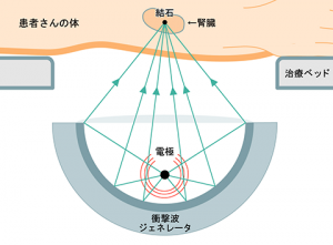 体外衝撃波結石破砕治療
