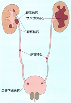 尿路結石